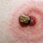 tick on a skin