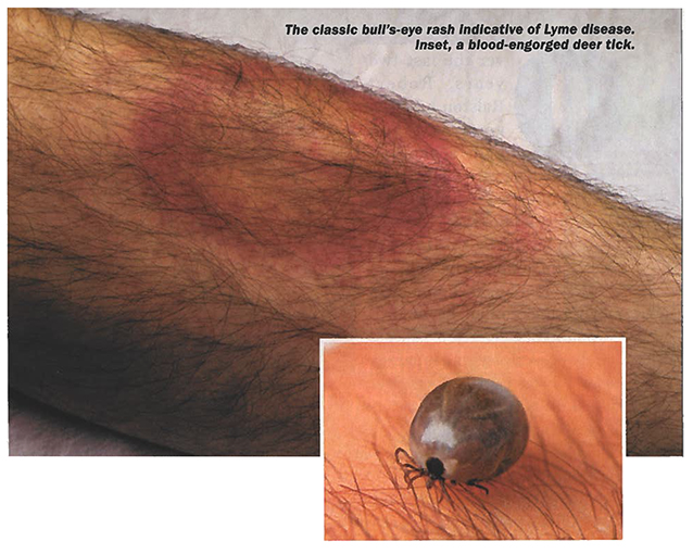 lyme disease